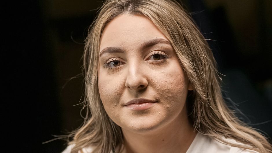 Помогает ли акридерм от прыщей